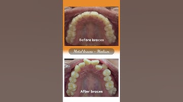Hành trình LỘT XÁC nhờ niềng răng của Kim Phụng #braces #shorts  #updental