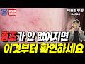 홍조 민감성피부 계속 된다면 이 영상을 꼭 확인하세요! - 피부과전문의 닥터피부광