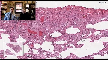 Pattern 2 - CTD Associated Fibrosing Lung Disease