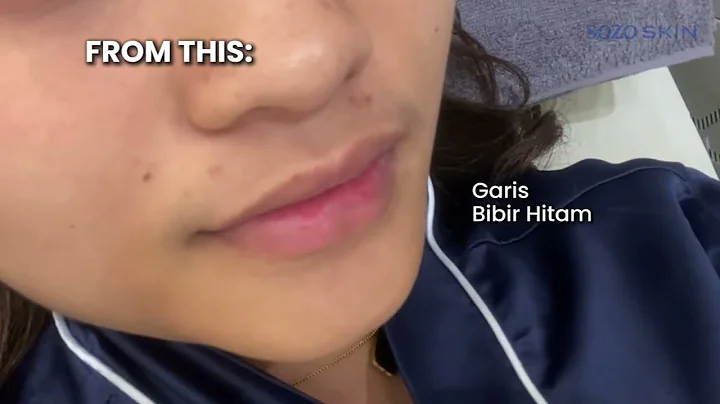 BIBIR PINK NATURAL DENGAN PINK LIPS LASER!💋😍