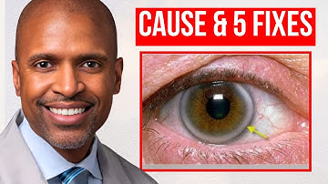 CORNEAL ARCUS (Causes & Cures) 2025