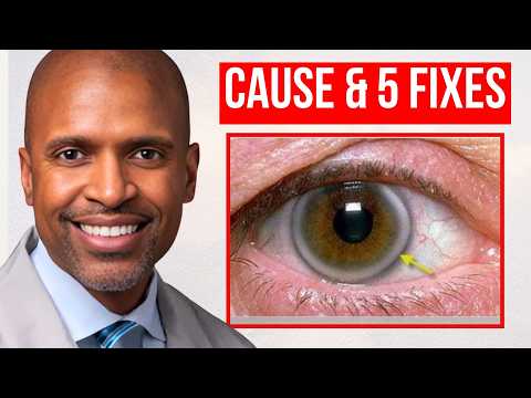 قوس القرنية الأسباب والعلاج 2025