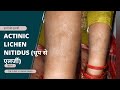 ACTINIC LICHEN NITIDUS ( धूप से खुजली, एलर्जी और सफ़ेद निशान) जानिए इसका कारण, लक्षण और उपचार !