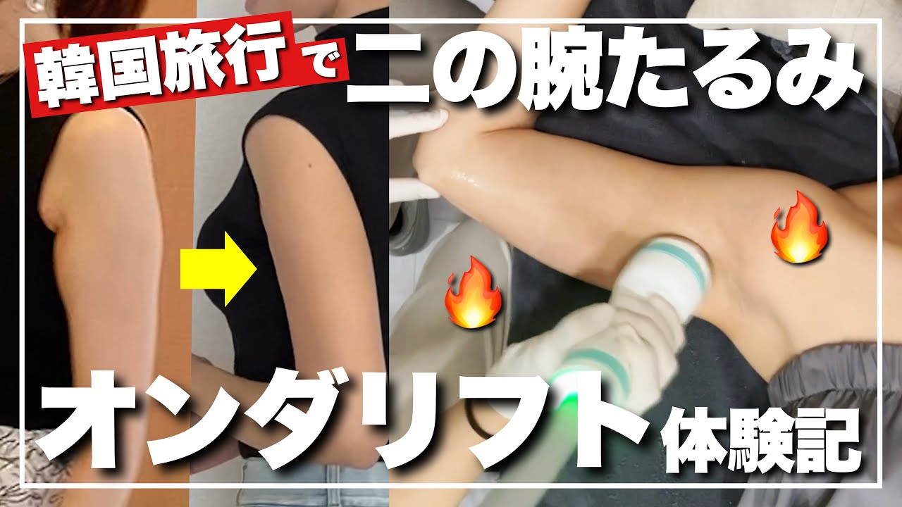 【韓国旅行】明洞エリア🇰🇷脂肪吸引が怖いならオンダリフトで部分痩せ🔥🔥🔥【韓国美容皮膚科】