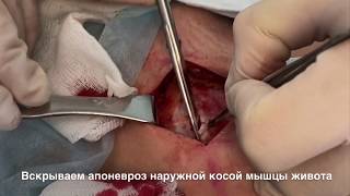 Паховая грыжа. Пластиката по Лихтенштейну. Lichtenstein Inguinal Hernia Repair