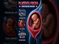 Fetal Complications of Placenta Previa | Risks to the Baby Explained
