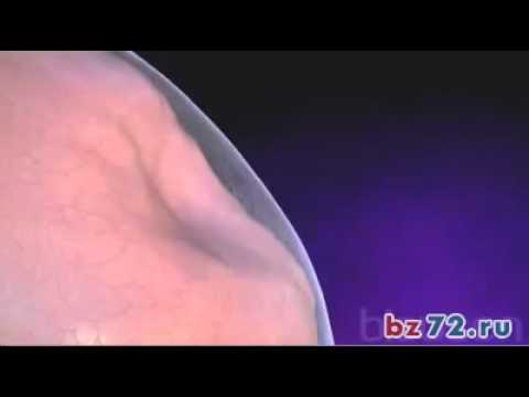 Пневмоторакс Медицинская анимация