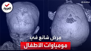 دراسة حديثة تكشف عن مرض شائع بمومياوات أطفال قدماء المصريين