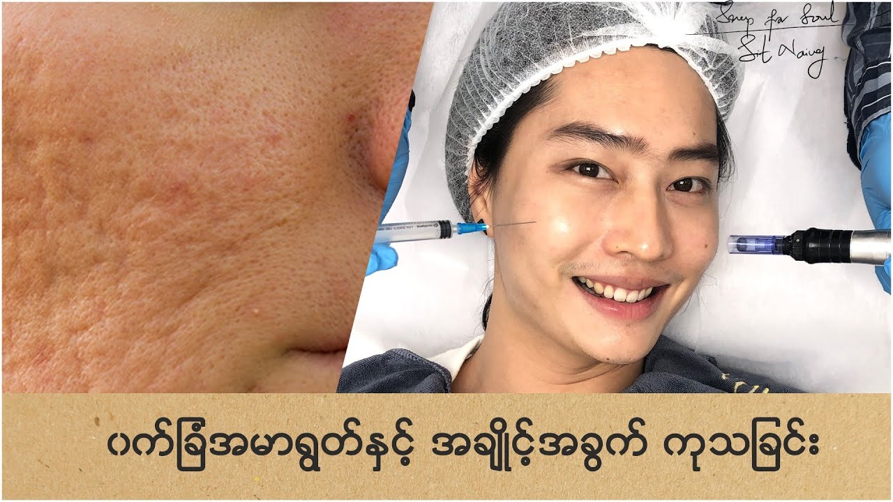 Acne Scar Treatment