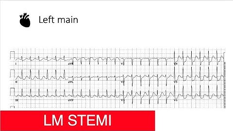 Left Main STEMI [Part 7]