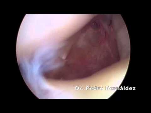 LESION DE SLAP II SUTURA ARTROSCOPICA DR BERNALDEZ