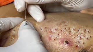 Treatment Of Blackheads And Hidden Acne #036