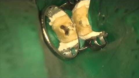 Self-Adjusting File on S-shaped lower molar (SAF)