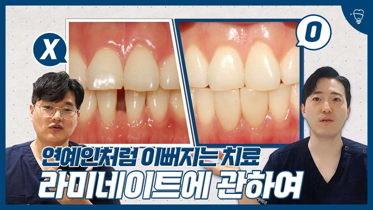 연예인 치아처럼? 라미네이트의 진실과 오해 총정리