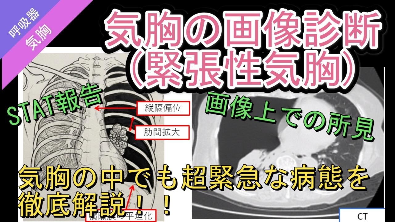 気胸の画像診断(緊張性気胸)