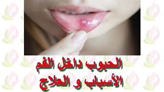 الحبوب داخل الفم الأسباب و العلاج screenshot 3