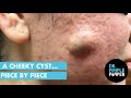 A Cheeky Cyst... Piece by Piece