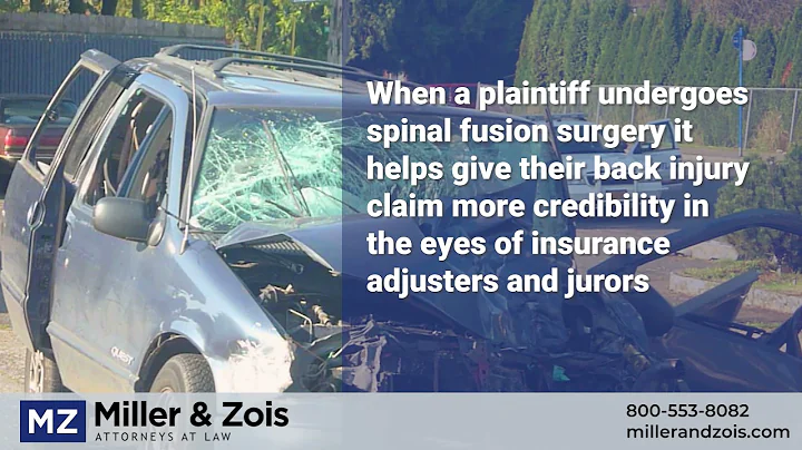 Spinal Fusion Surgery Settlement Value in Accident Cases