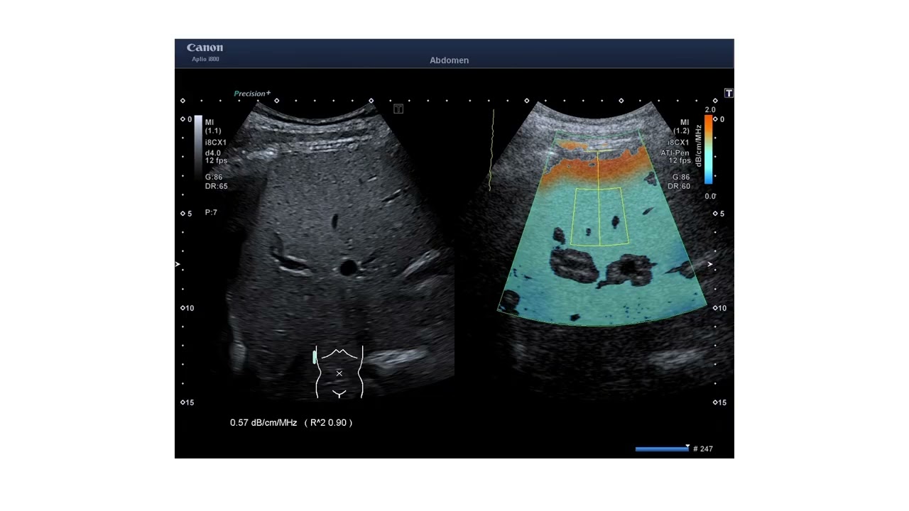 Multiparametric ultrasound for steatotic liver disease with a focus on fat quantification