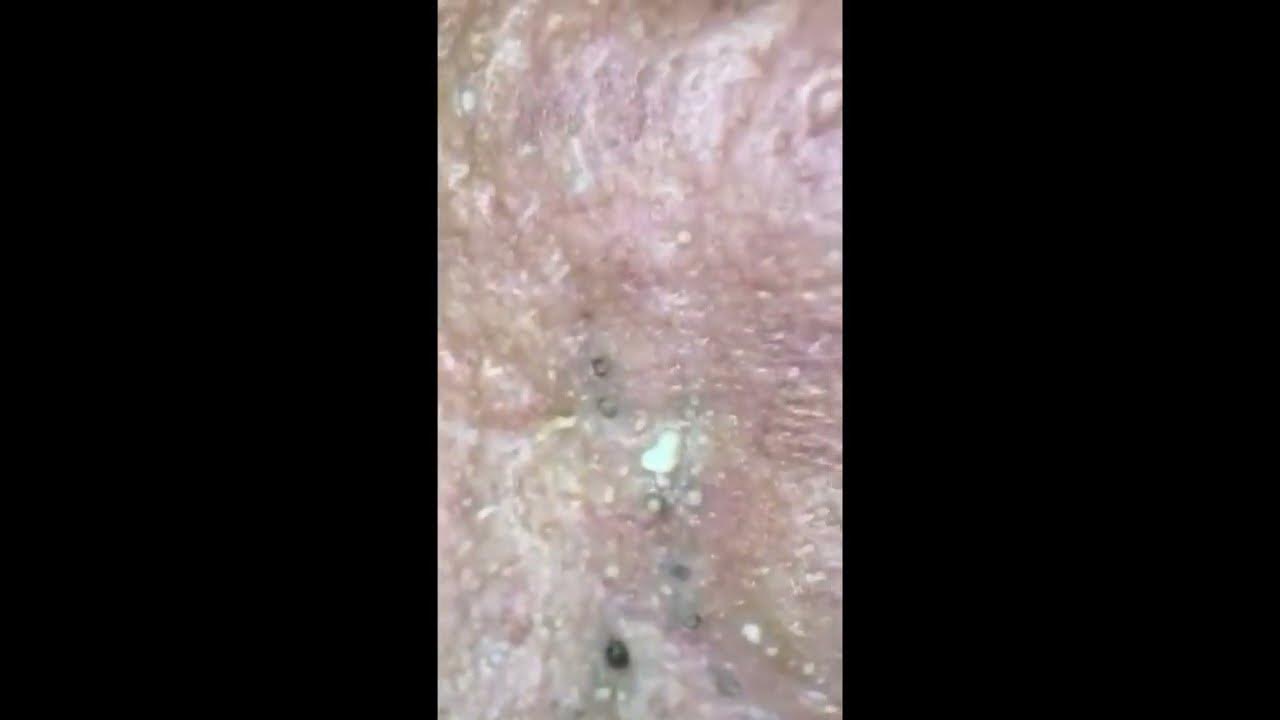MULTIPLE BlackHeads Extracted (Blackheads Removal Videos 2023) YouTube
