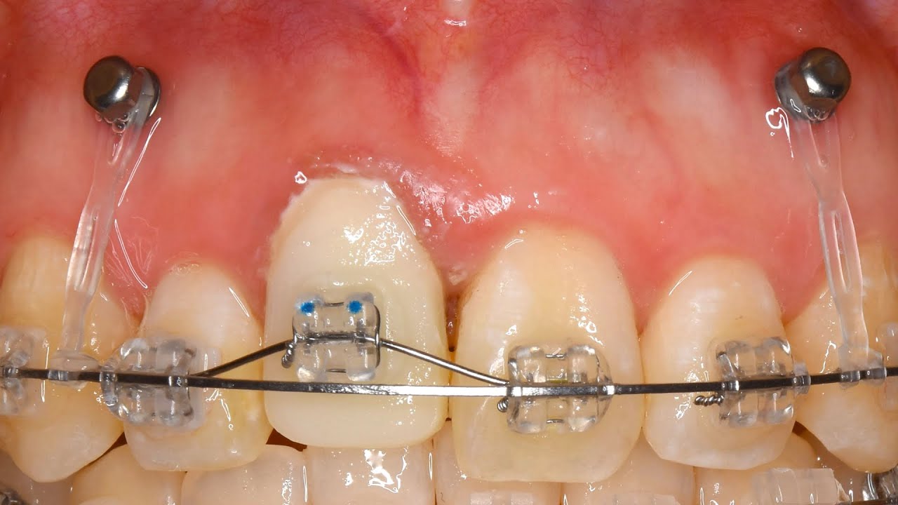 ガミースマイルと長すぎる前歯（かぶせもの）の矯正治療　Orthodontic treatment for gummy smiles and overly long front teeth