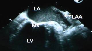 Detection of Left Atrial Appendage Thrombus by TEE
