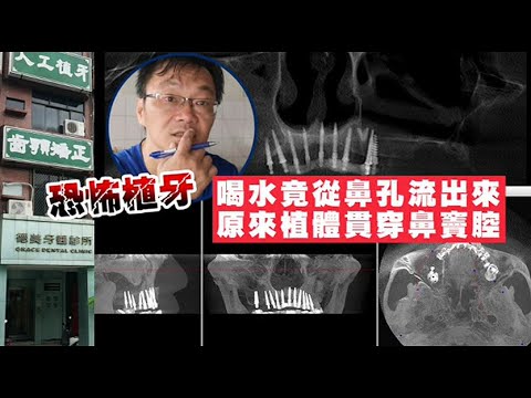 恐怖植牙喝水竟從鼻孔流出來　原來植體鑿穿鼻竇腔 #獨家 | 台灣 蘋果新聞網