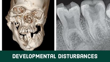 DEVELOPMENTAL DISTURBANCES |ASPIRE MDS | BHAUMIK JOSHI | NEET | AIIMS| MDS