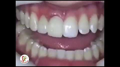 Quá trình bọc răng sứ cho những răng thưa, to nhỏ bất thường so với những răng khác trong hàm