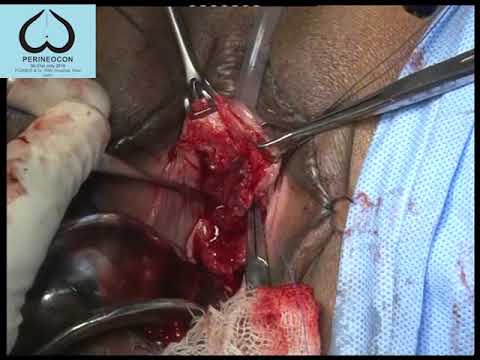 Video: Urethraal Divertikel: Behandeling, Chirurgie En Herstel