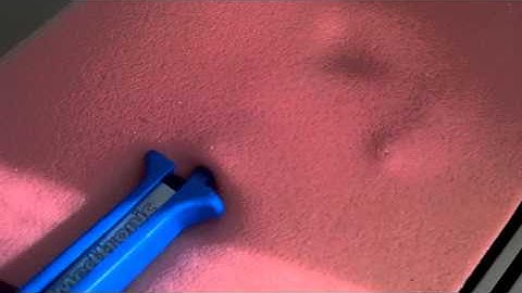 How to implant the new insertable loop recorder