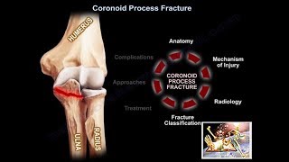 Coronoid Process Fracture - Everything You Need To Know - Dr. Nabil Ebraheim