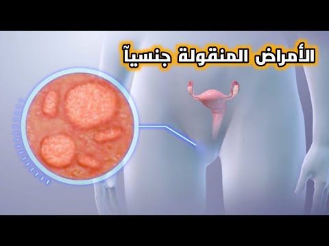 يعني اية امراض منقولة جنسيا وما هي الاعراض والاسباب وطرق العلاج    