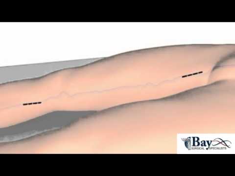 Ligation and Stripping of Varicose Veins Surgery