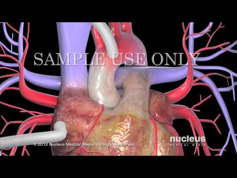 Vídeo: Intervención Percutánea Versus Cirugía De Revascularización Coronaria En La Estenosis De La Arteria Coronaria Principal Izquierda: Una Revisión Sistemática Y Un Metanálisis