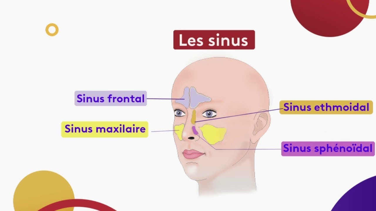 La sinusite