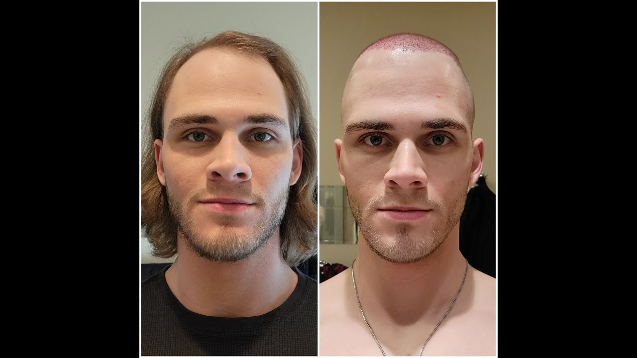 my hair transplant journey