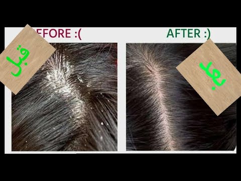 الشعر علاج نهائياً قشرة علاج القشرة