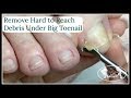 Pedicure Tutorial: Digging Out Hard To Reach Buildup Prior Ingrown Toenails That Causes Pain