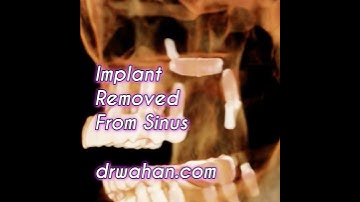 Implant and Tooth Root Removed From Sinus with Dr. Wahan Black + White