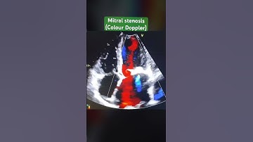 Mitral stenosis -colour Doppler 2D echo #cardiology #echocardiography