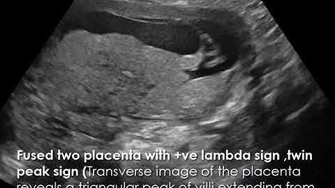 CASE 546 Fused two placenta with lambda sign ,twin peak sign