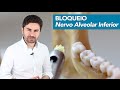 Passo-a-Passo do Bloqueio do Nervo Alveolar Inferior | Prof Fernando Giovanella