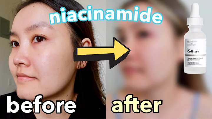 I Tried The Ordinary Niacinamide 10%zinc Every Day For A Week Before After