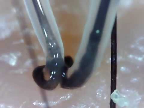 Hair Root Close Up Part 66 4本同時に透明毛根鞘 Quadruple Root Sheath Youtube