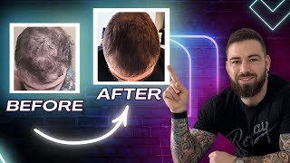 New hair Loss Protocol! RU58841, Finasteride And More