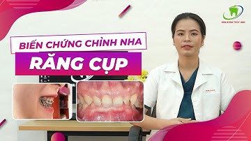 RĂNG CỤP – SẮP THÁO MẮC CÀI MÀ RĂNG VẪN CỤP – BIẾN CHỨNG CHỈNH NHA