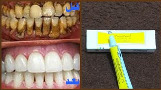 أقسم بالله لن تلجأ لطبيب الأسنان لتبييض الأسنان ولإزالة الجير سيسقط وحده بعد مداومة الوصفة#بقا_بالبي