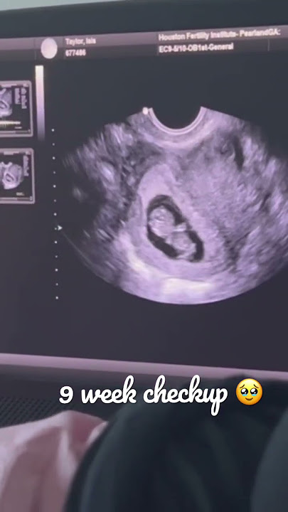 Baby Taylor did a little wiggle, wiggle for us. Live 9 Week Ultrasound.  #Pregnancy #IvfPregnancy