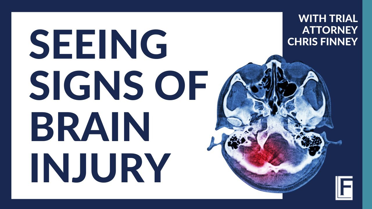 How Long Does it Take to Show Signs of a Traumatic Brain Injury? | St. Louis Brain Injury Lawyer